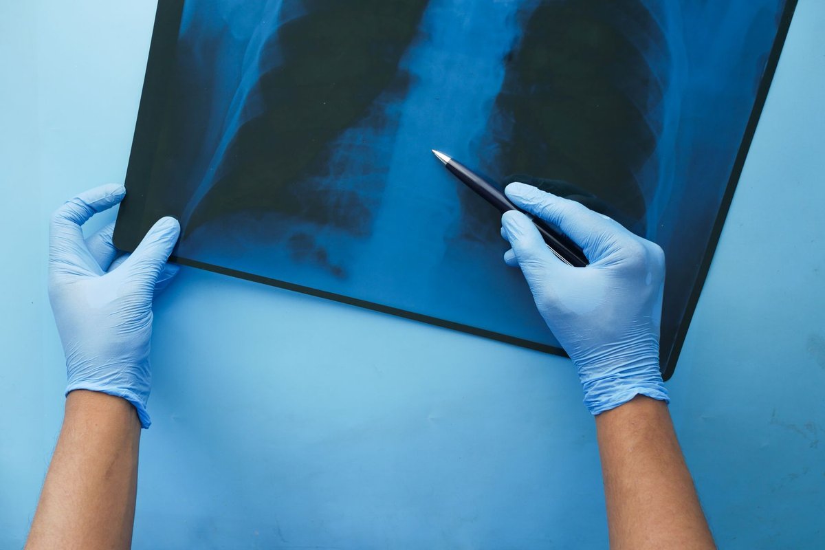 épanchement pleural espérance de vie